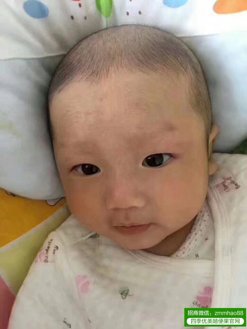 夏天湿热重，随便果水如何改善小孩湿疹？