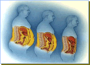 六种肥胖人群的类型，看看你是哪一种